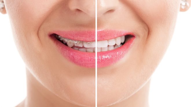 Fiksni retener – zakaj ga je treba nositi po zaključenem ortodontskem zdravljenju?