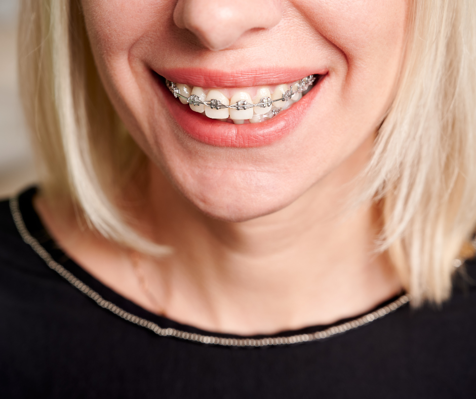 Vrste zobnih aparatov – blog – Ortodent