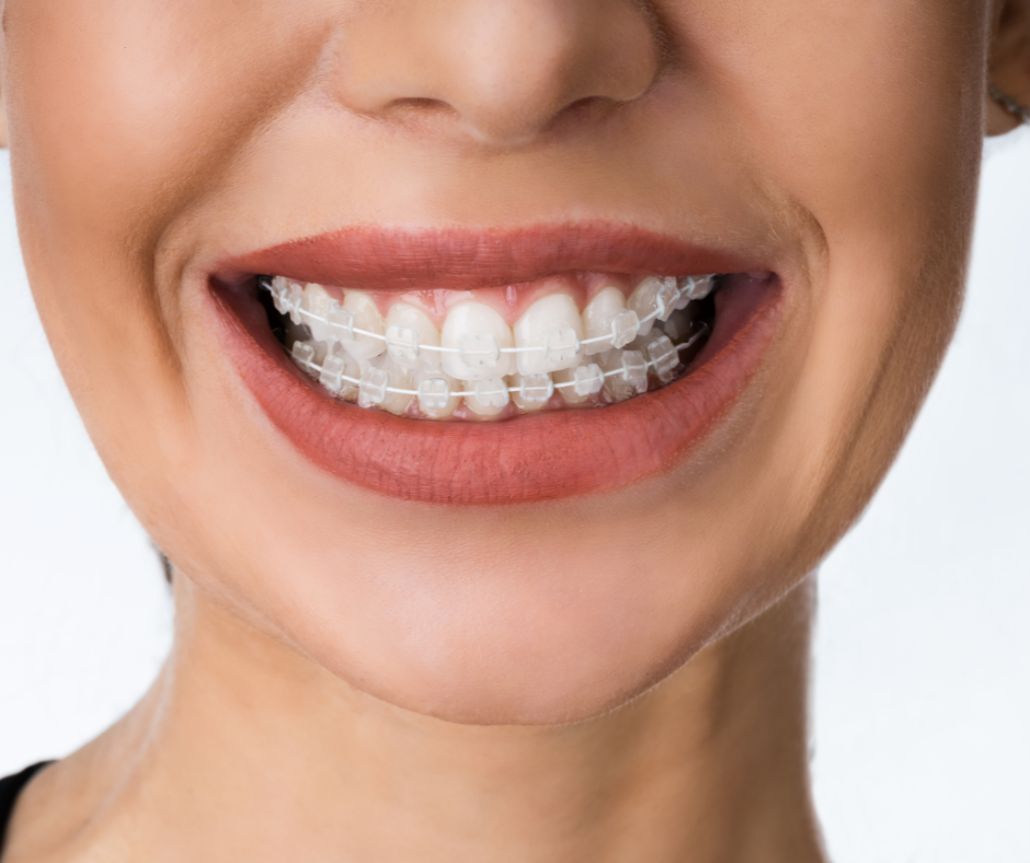Vrste zobnih aparatov – blog – Ortodent