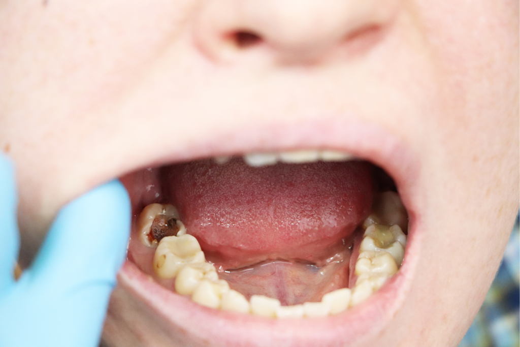 Povezava med ustno higieno in splošnim zdravjem - blog Ortodent